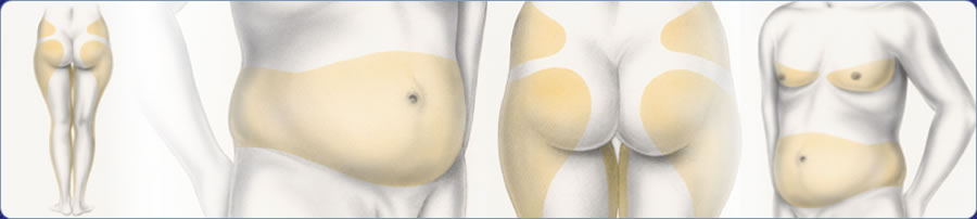 Резервная жировая ткань очень медленно уходит при похудании, и постоянно существует в определенных областях, заметно ухудшая контур тела