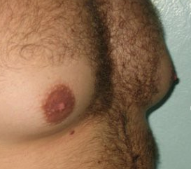 увеличение грудных желез у мужчин